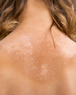 Sun Damage