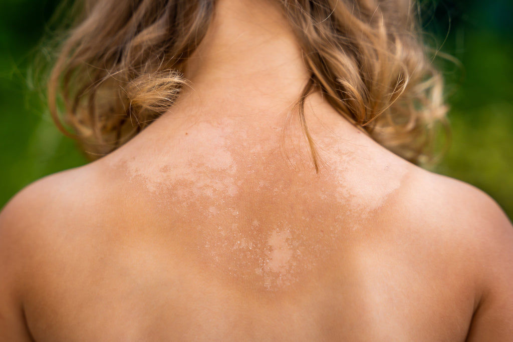 Sun Damage